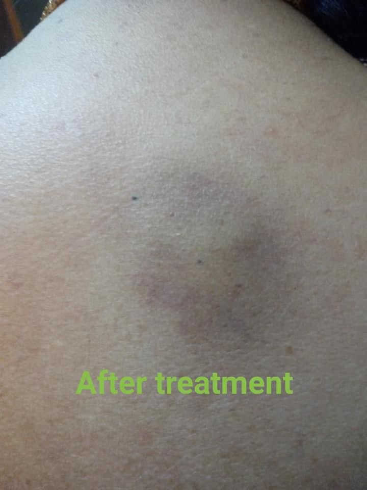 After Treatment