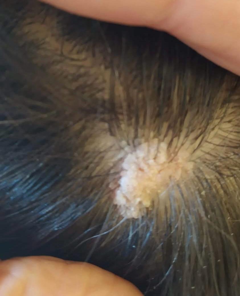 Before Treatment