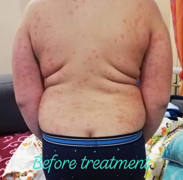 Before Treatment
