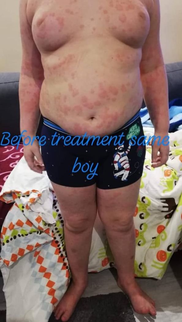 Before Treatment