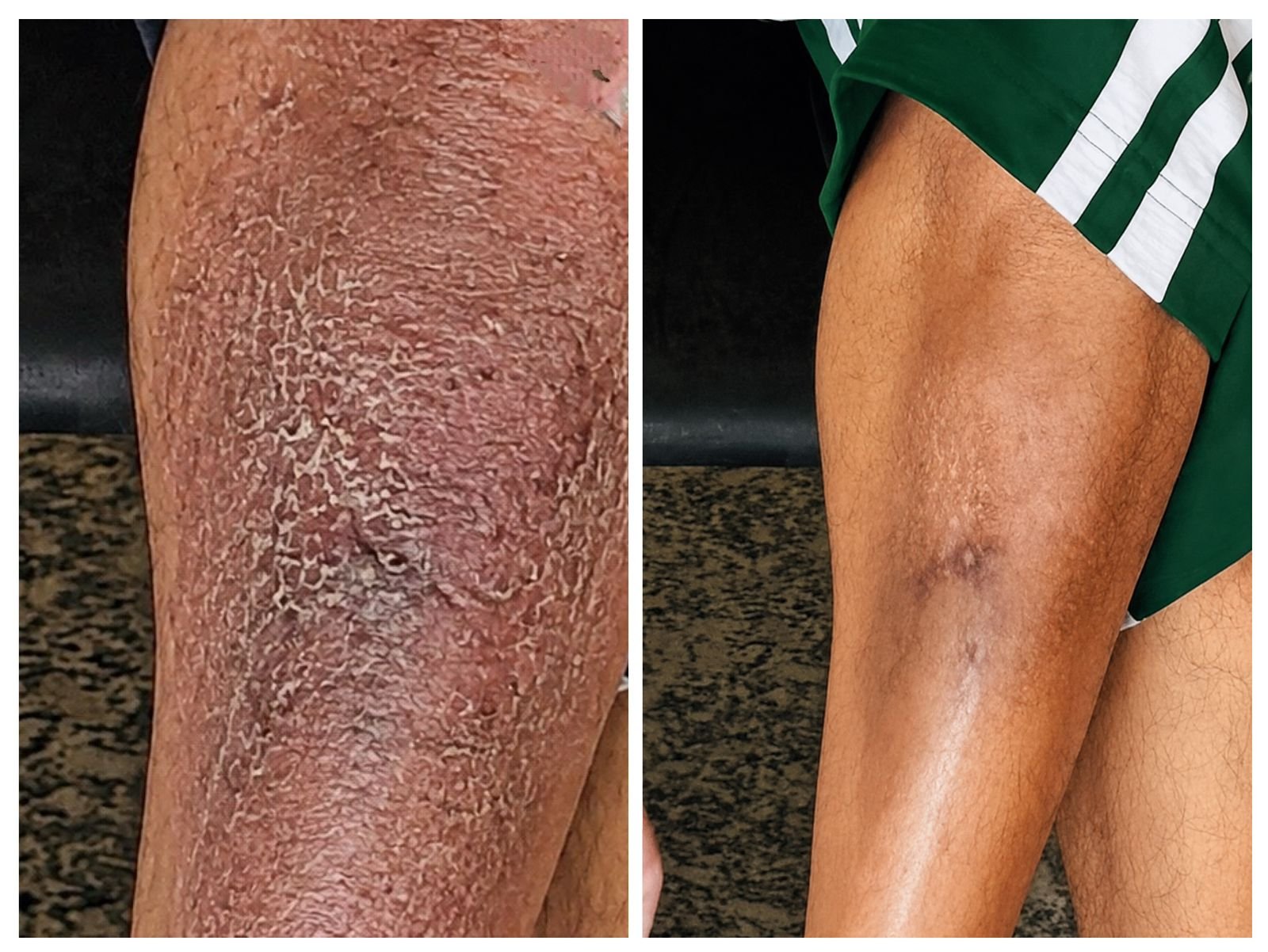Before & After Treatment