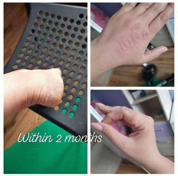 After Treatment