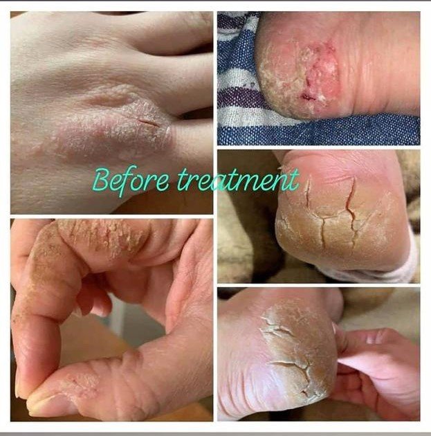 Before Treatment
