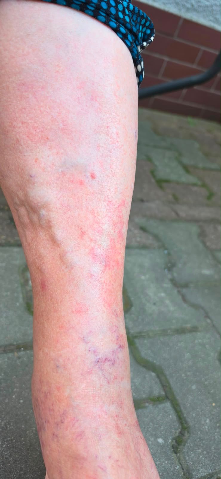 Venous Insufficiency