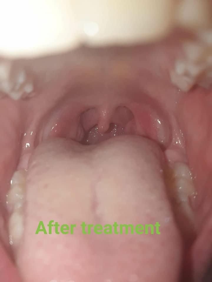 After treatment