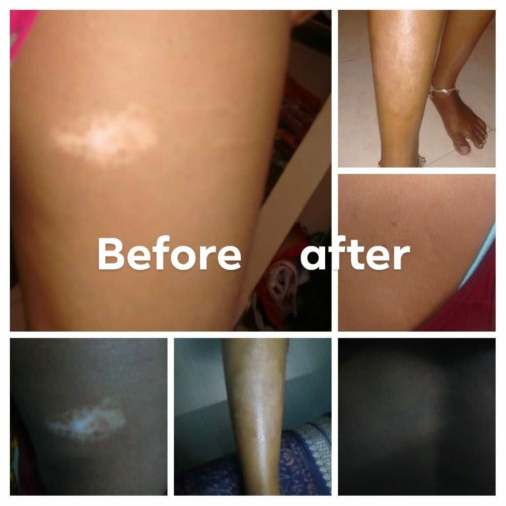 Before & After Treatment