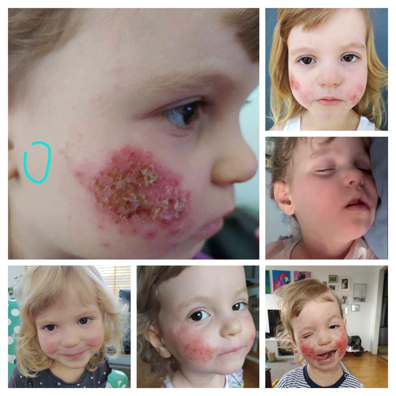 Wet Eczema